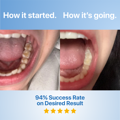 Reumi Tooth Repairing Powder